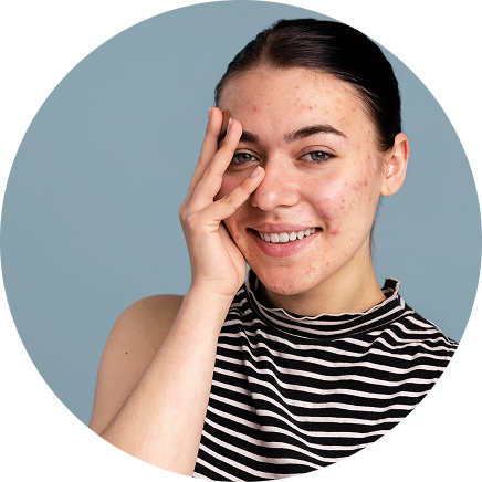 Teen acne (puberty-driven)