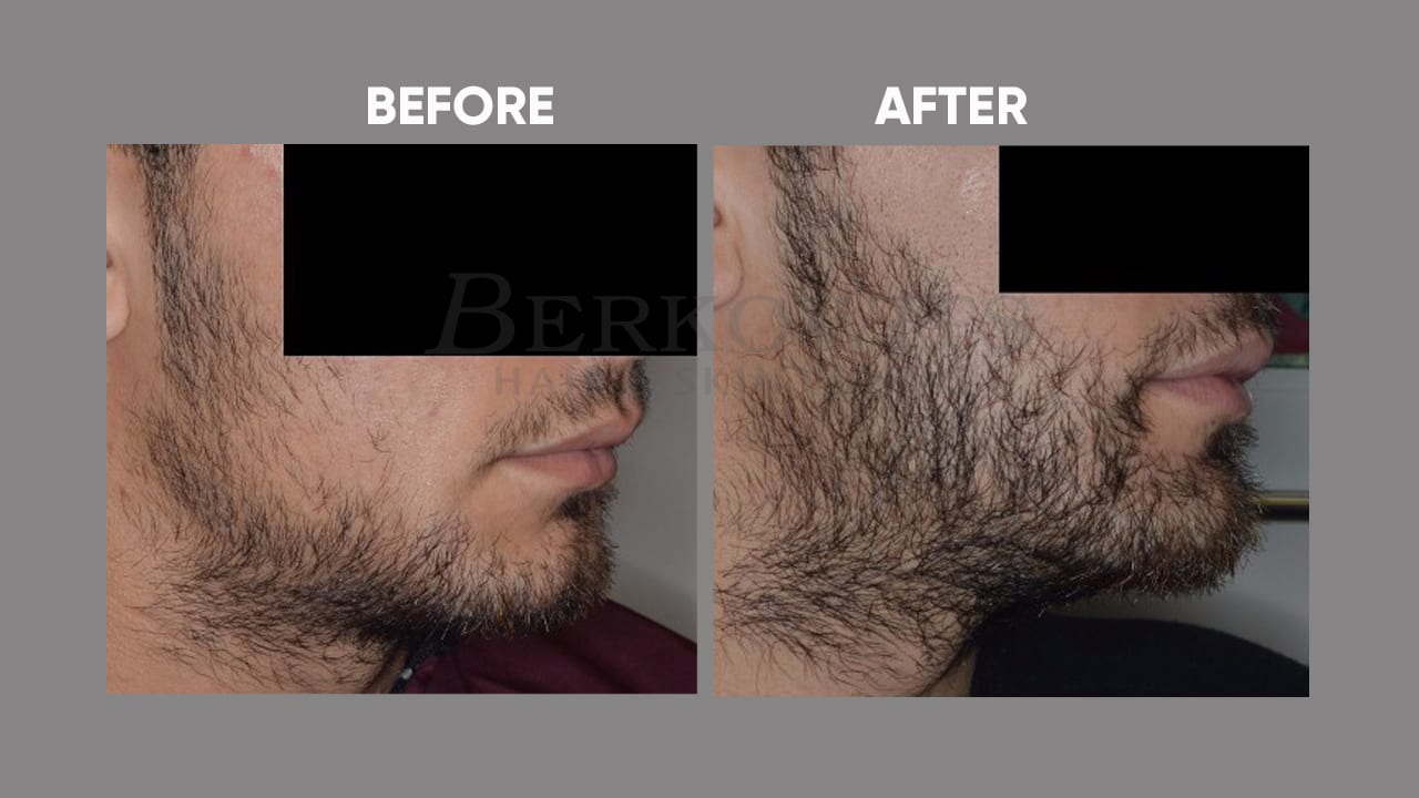 Facial Hair Transplant - Berkowits Hair & Skin Clinic