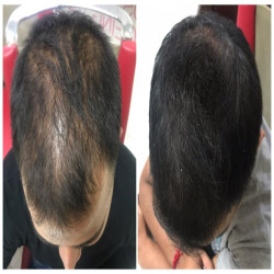 Hair Fall Control Kit | For Men and Women | For All Hair Types