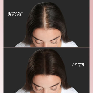 Berkowits Grow Minoxidil 5% Solution Enriched with Saw Palmetto Clinically Proven to Help Regrow Hair