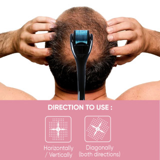 0.75 mm Micro-Needling Derma Roller With 540 Stainless Steel Needles