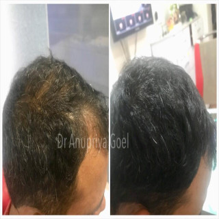 Berkowits Foaming Serum Combo - Enhance Hair Density