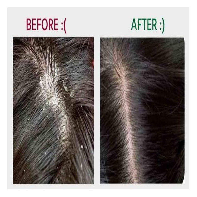 Berkowits Clear Shampoo for oily scalp and Anti Dandruff Get free Clear Conditioner (440ml)