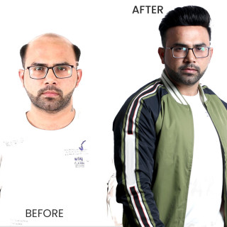 Buy Natural Hair Patch for Men – Realistic & Comfortable Wig