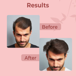 Berkowits Grow Hair Tonic - Advanced Hair Growth Formula (50ml)